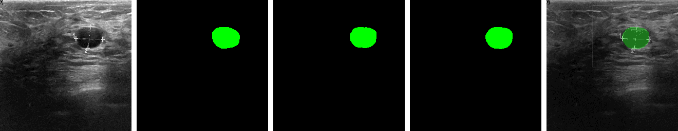 Benign lesion segmentation result (Jaccard 0.967)