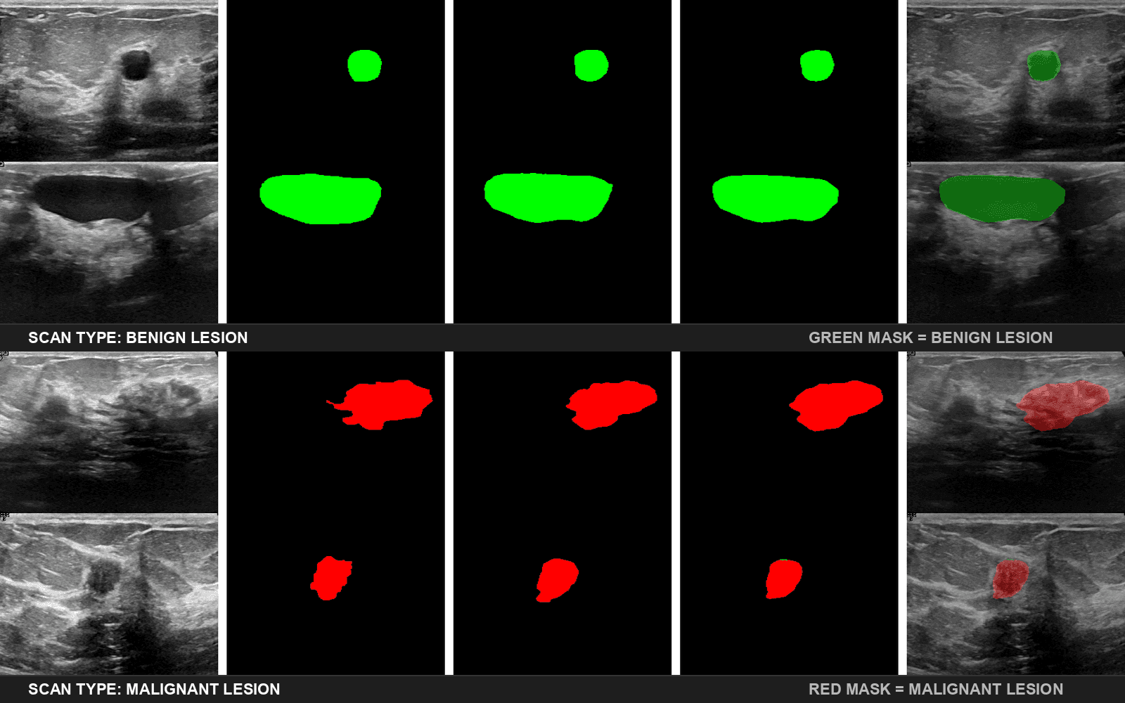 High-precision medical image segmentation, Hybrid Xception-VGG DoubleUNet